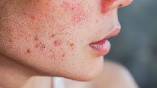 Severe acne/rosacea, vertigo and untreated parasitic infection
